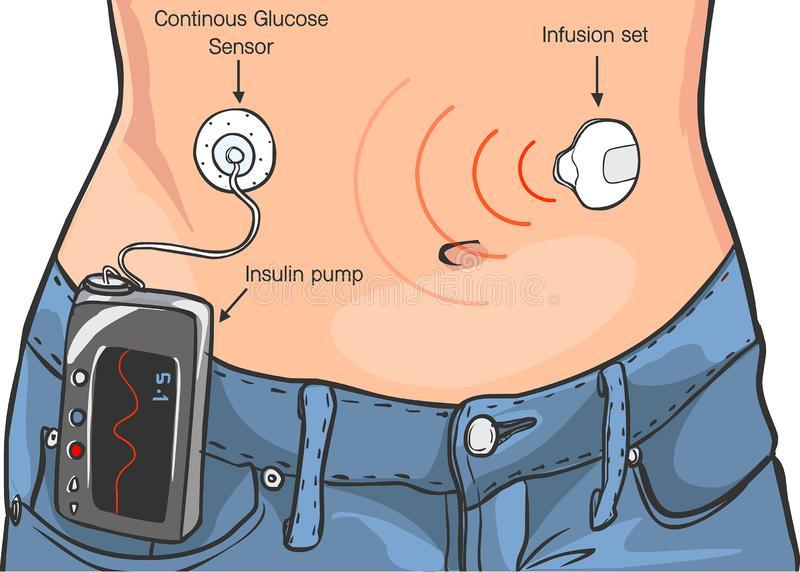 Insulin Pump Treatment